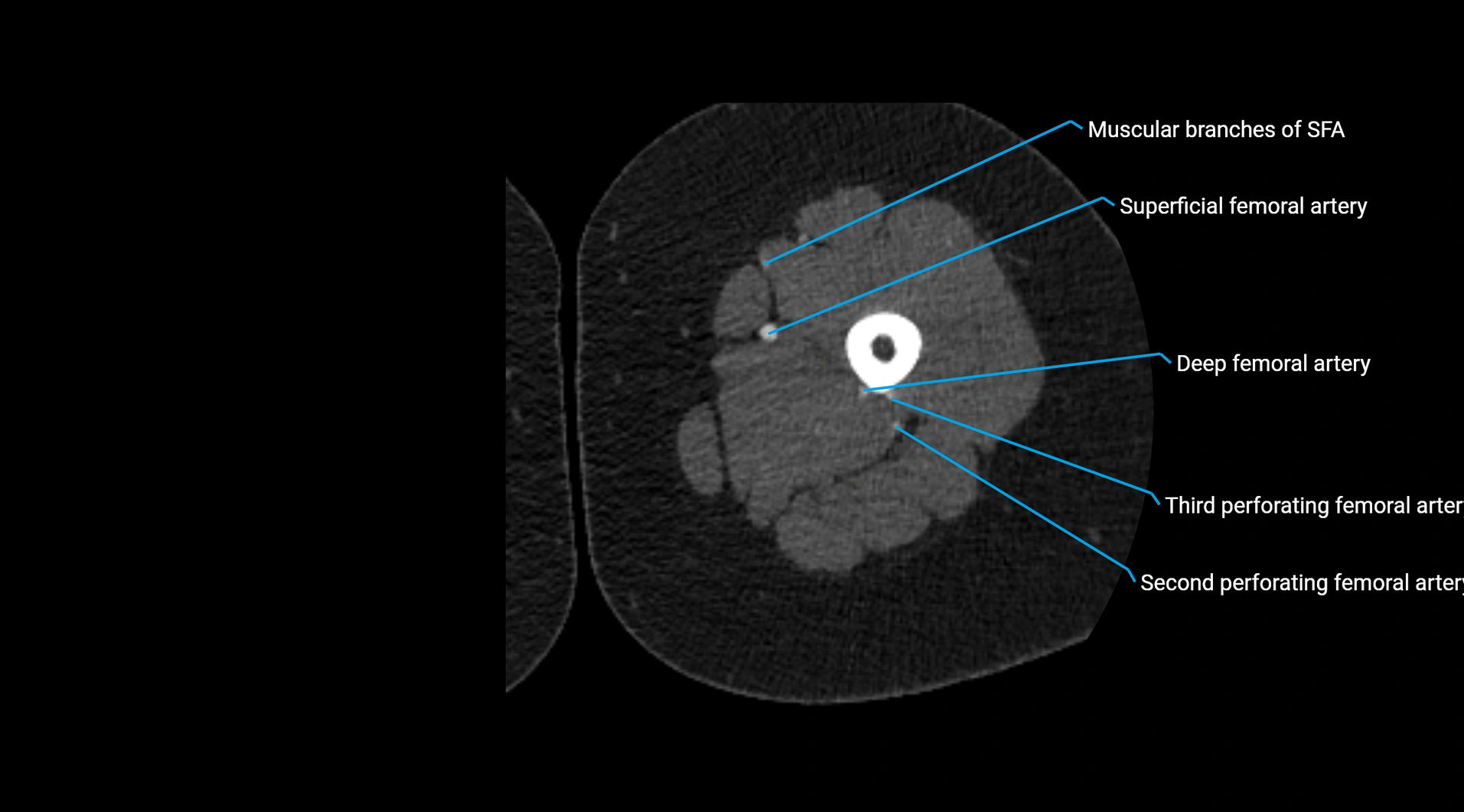 CTA lower limb cross sectional anatomy labelled image _118.webp